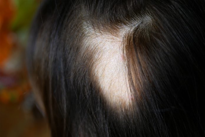 Alopecia Areata