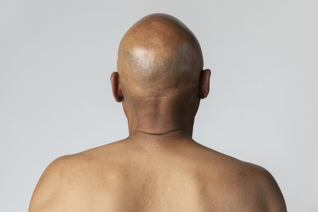 Clasificación de alopecia