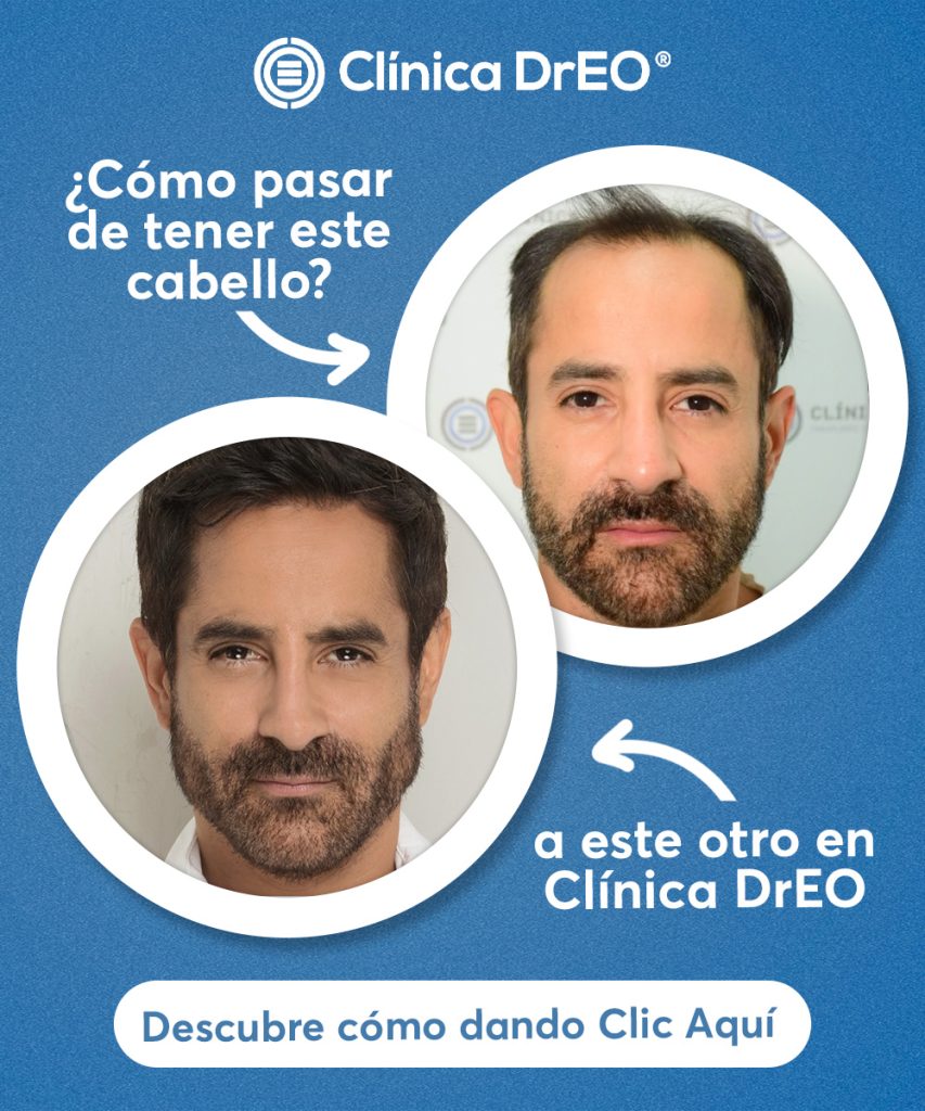 Injerto de cabello antes y después